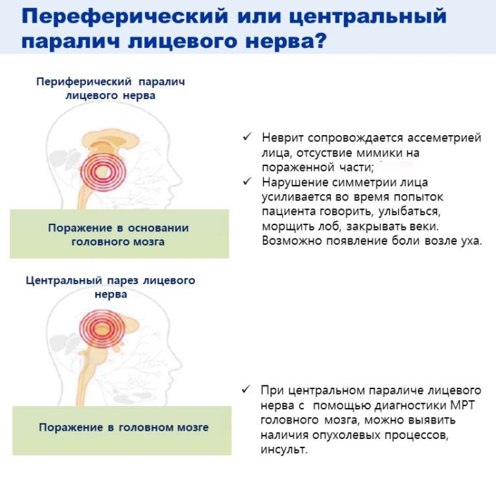 Для периферического (вялого) паралича характерно. Парез лицевого нерва у новорожденного. Вялый и спастический паралич. Как вылечить парез. Как вылечить парез.