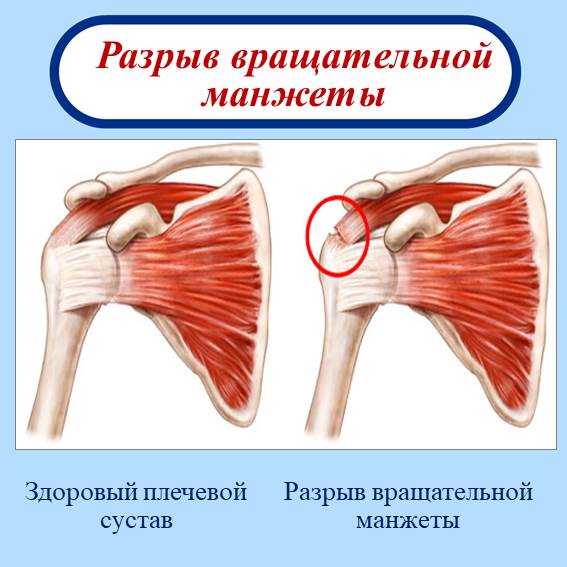 Сухожилия плеча- капсулит. Повреждение манжетки плечевого сустава Кальцифицирующий тендинит надостной мышцы плеча | Кислицын Михаил Андреевич Анатомия плечевого сустава, классификация повреждений и заболеваний.
