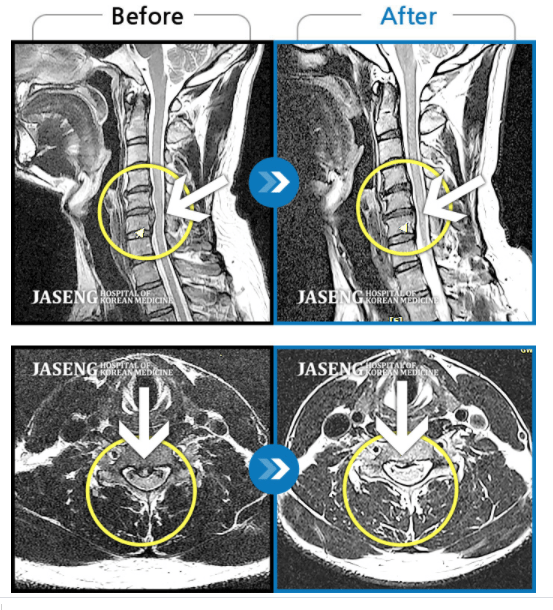МРТ до и после. Грыжа в шее рассосалась без операции!